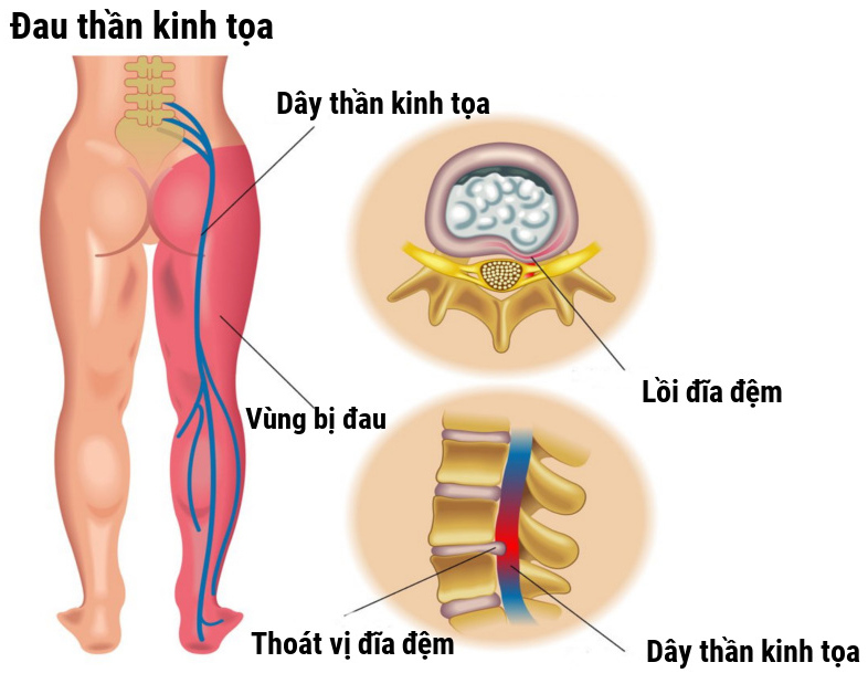 Đau thần kinh tọa có nguy hiểm không