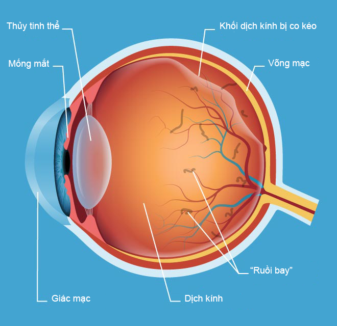 nguyên nhân gây vẩn đục dịch kính 